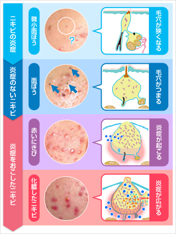 にきび治療