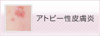 アトピー性皮膚炎