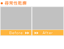 尋常性乾癬 Before After