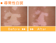 尋常性白斑 Before After