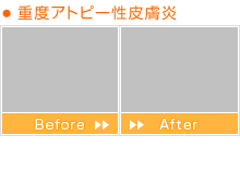 重度アトピー性皮膚炎 Before After