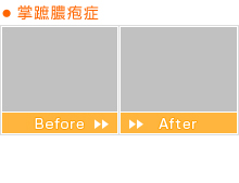 掌蹠膿疱症 Before After